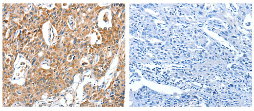 Иммуногистохимия: залитая в парафин ткань рака легкого человека, окрашенная антителами anti-Bax antibody (слева) в разведении 1/30, или тем же антителом, предварительно инкубированным с антигеном (справа). Увеличение: X200.